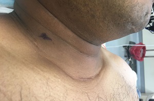 Neck scaring from grafting surgery